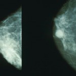 Femeile inalte sunt predispuse la mai multe tipuri de cancer