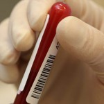A fost aprobat noul test pentru diagnosticarea HIV